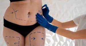 liposukcija